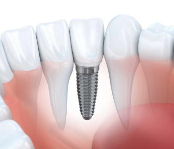dental implant procedure from Dentist in Etobicoke On