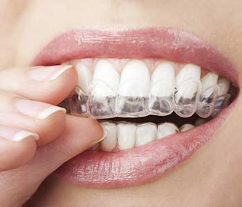 Most Frequently Asked Questions About Invisalign Orthodontics in  Mississauga, ON