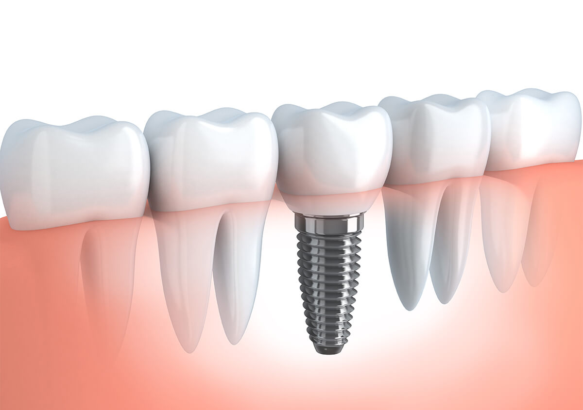 Dental Implant After Care in Etobicoke ON Area