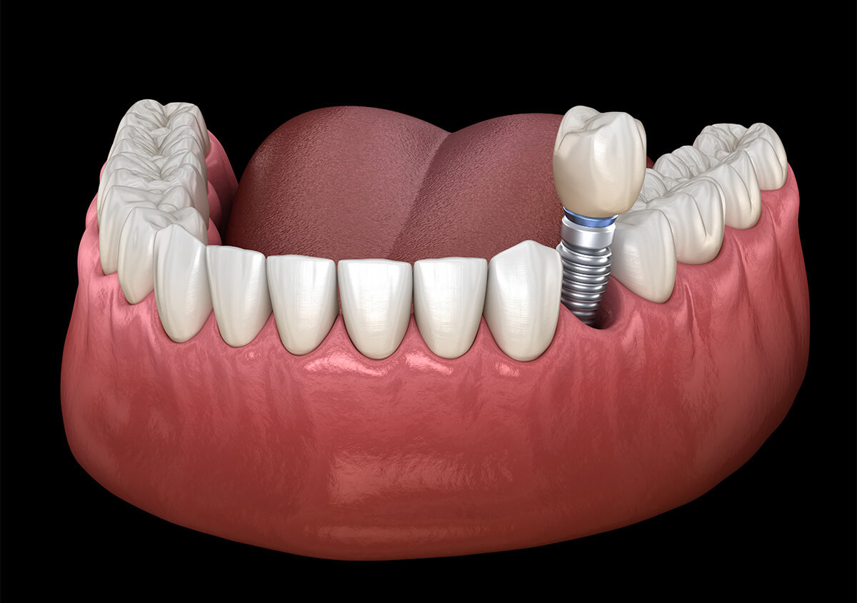 Dental Implants Dentist in Etobicoke ON Area