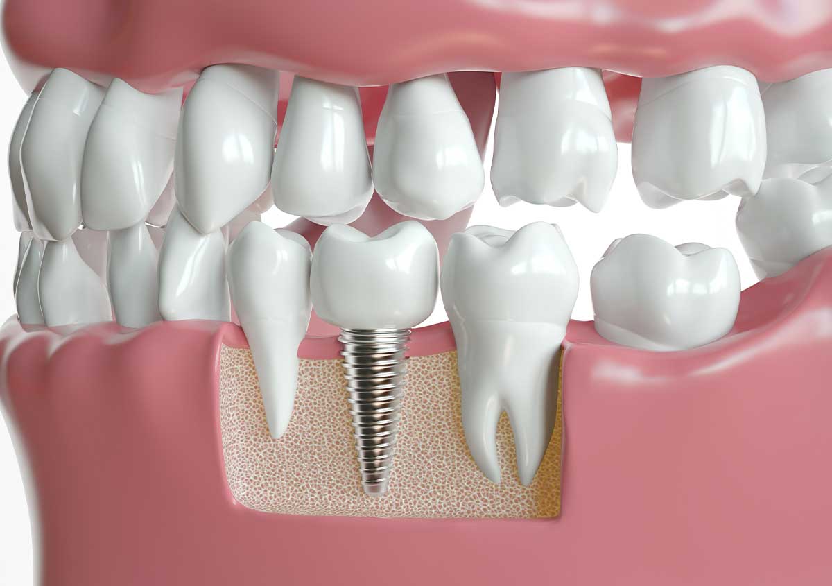  Dental Implants for Teeth in Etobicoke ON Area