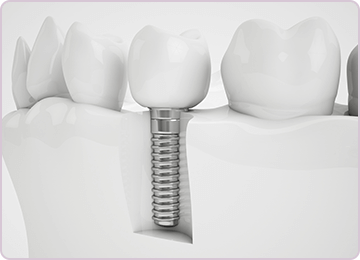 Dentist Etobicoke - Dental Implants