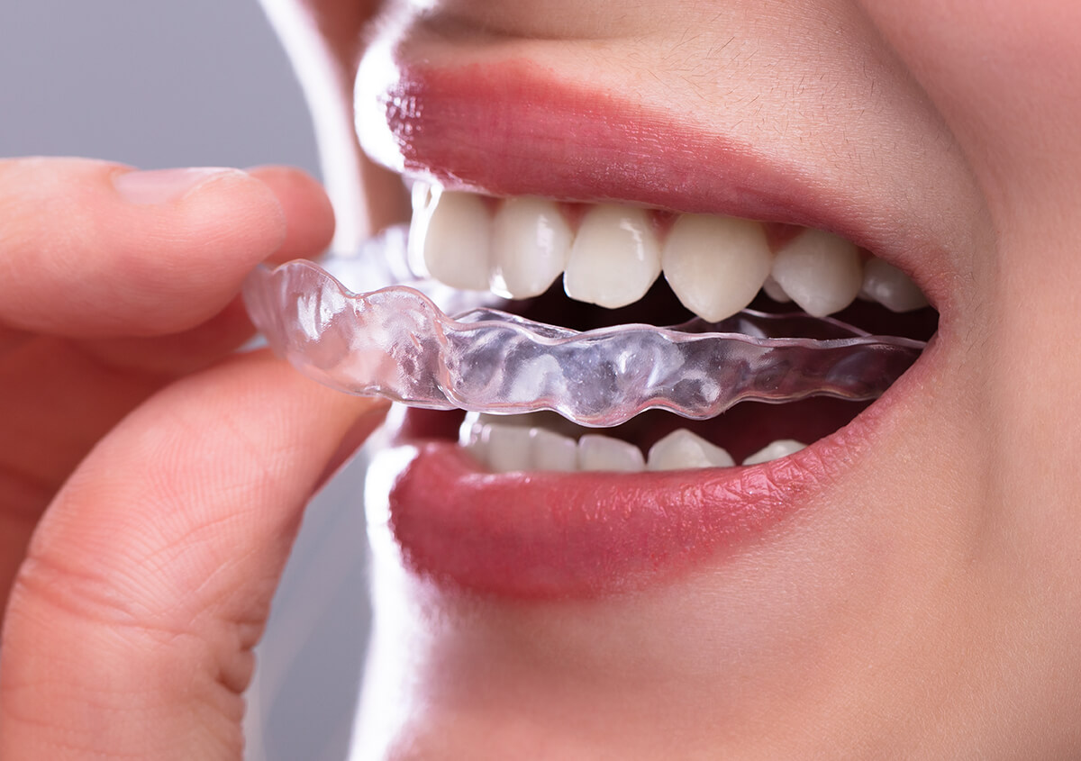 Dentist in Etobicoke, ON Area Explains how Invisalign Clear Braces Work and Their Benefits