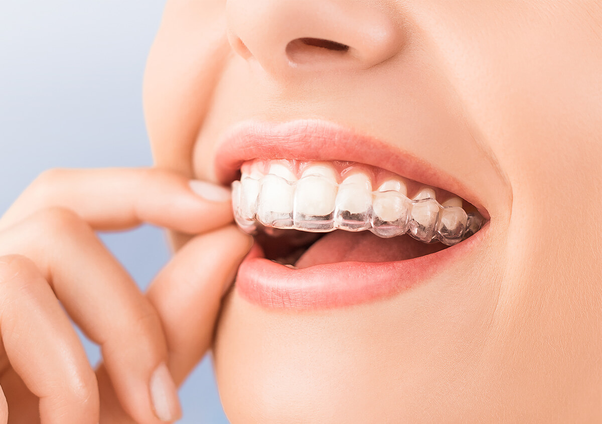 Invisalign Teeth Straightening in Etobicoke ON Area
