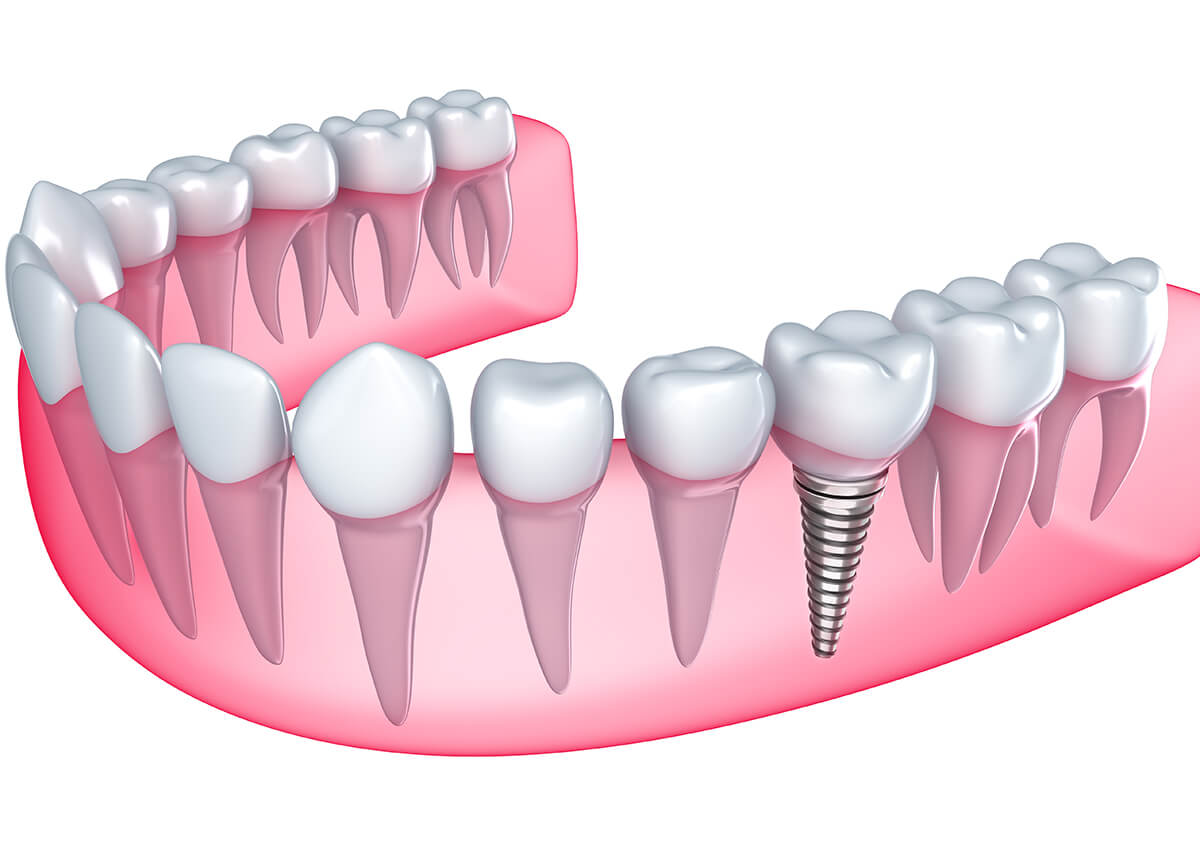 Replace Missing Teeth with Dental Implants Treatment in Etobicoke, ON Area